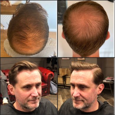 hair transplant advice Bristol
